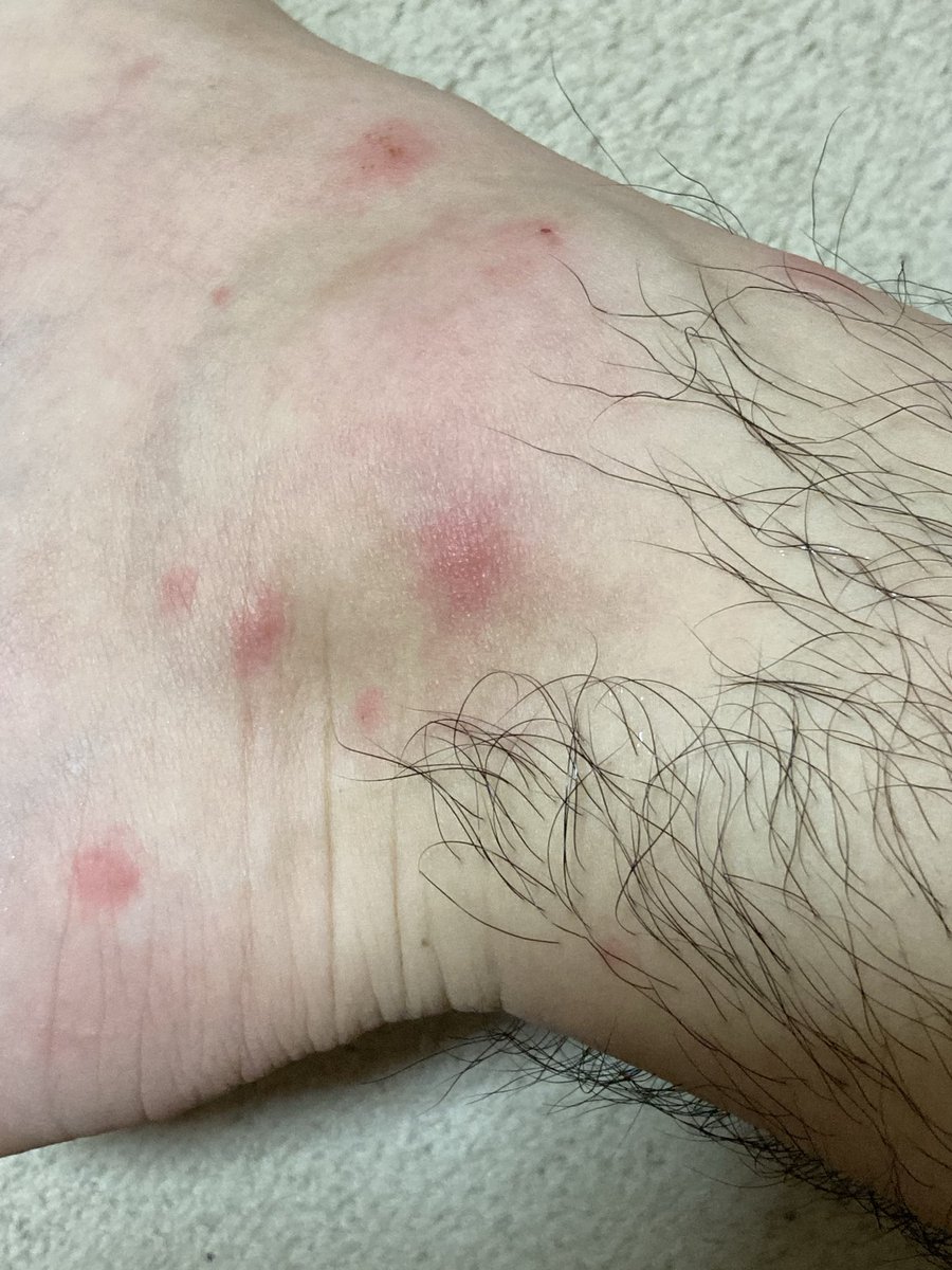 ginomasa's tweet photo. この間オニヒラ釣った後からずっと両足痒くてこんな感じなんだけどこれ何？浸出液まで出てきてる　ヌカカってやつに刺されたのかなぁ
長ズボンと靴下履いてたのに　上から刺してきたって事？ https://t.co/kXieDvRS7s