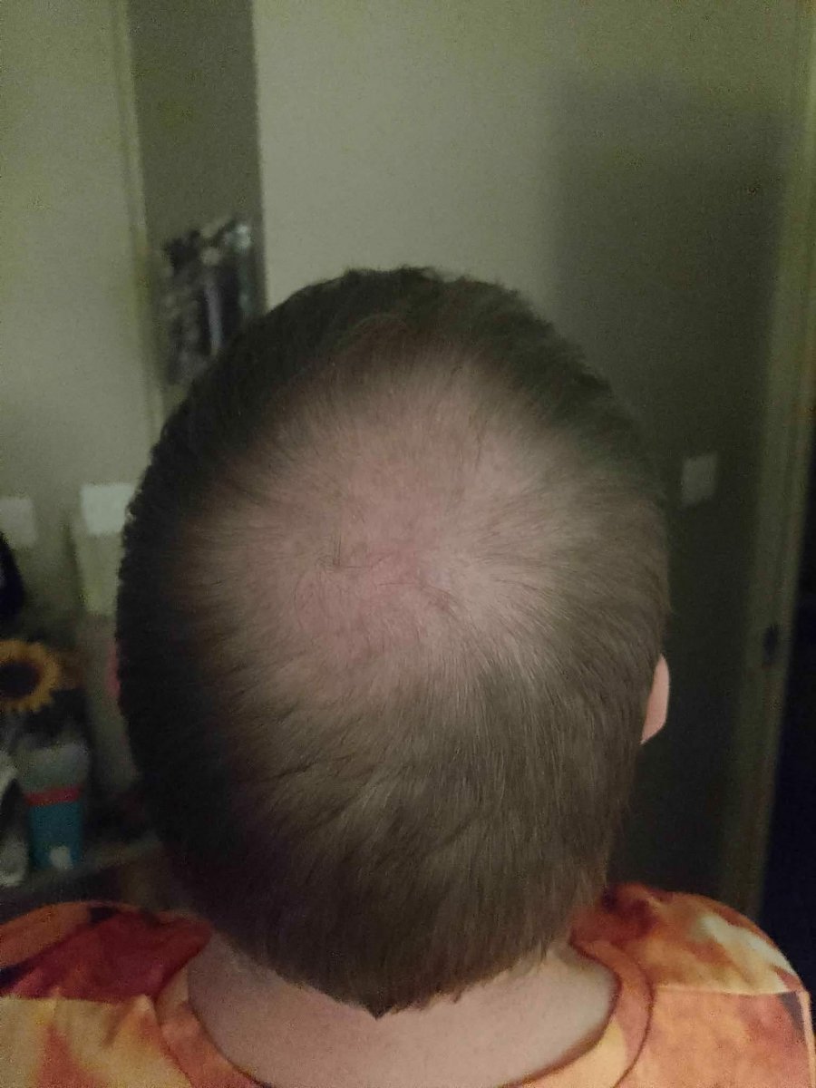 SCCARTWRIGHT1's tweet photo. About ten months ago I flew out to Turkey for a hair transplant because my double crown was getting excessively big , now the results are here and it's growing back rapidly ☺️😊😁😜 https://t.co/hVJOtqYmoh