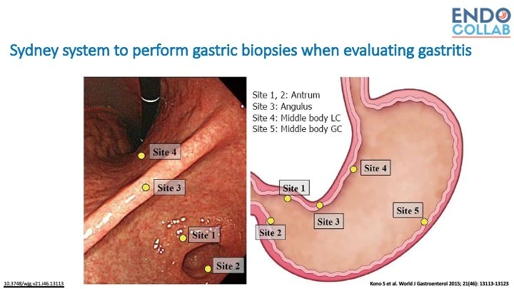 EndoCollabcom's tweet photo. Sydney Protocol to Obtain Biopsies in Gastritis https://t.co/wDQBgQivXN