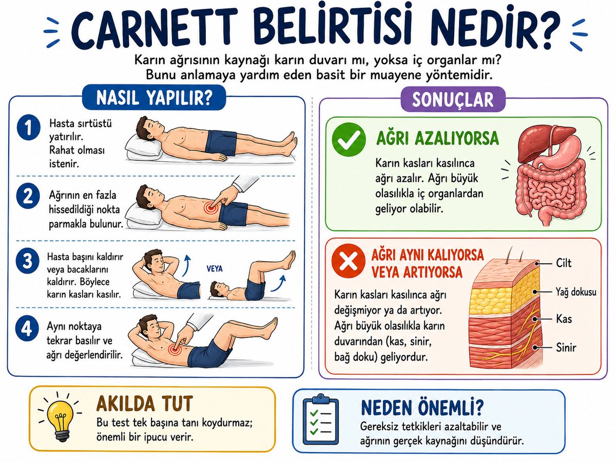 Ferhatarslandr's tweet photo. Tıp Okulu

Karın ağrısı her zaman bağırsaktan, böbrekten, apandisten gelmez.

Bazen ağrının kaynağı karın duvarıdır; yani kas, sinir, bağ dokusu.

Bunu anlamanın basit bir yolu var: Carnett belirtisi.

Hasta sırtüstü yatar. Ağrıyan nokta bulunur. Sonra hasta başını kaldırır ya da bacaklarını kaldırıp karın kasını sıkar.

Eğer bu sırada ağrı azalıyorsa, ağrı daha çok içerideki organlardan geliyor olabilir.

Ama ağrı artıyor ya da aynı kalıyorsa, “dur bakalım, bu bağırsak değil; karın duvarı-kas-sinir ağrısı olabilir” deriz.

Yani mesele basit:

Kas gevşekken ağrıyor, kas sıkılınca daha da belirginleşiyorsa; suçlu bazen bağırsak değil, karın duvarının kendisidir.

Bu yüzden aylarca “gaz mı, bağırsak mı, böbrek mi?” diye dolaşan bazı hastalarda iyi bir fizik muayene, koca koca tetkiklerden daha fazla şey söyler.