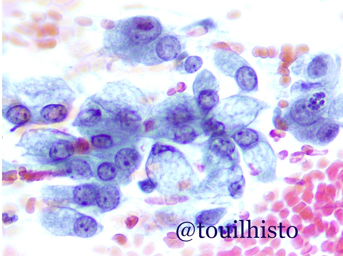 touilhisto's tweet photo. Pap smear
Endocervical cells or endocervical nuclei
#papsmear #cytology #cytopathology #piccytotwitter https://t.co/BlssWkHSNC