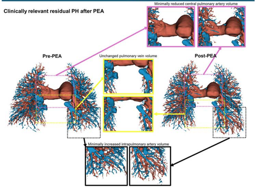 AJRCMB's tweet photo. Pulmonary blood volumes on computed tomography predict residual pulmonary hypertension post–pulmonary endarterectomy

https://t.co/0NiwxnjKc1

@atscommunity https://t.co/8HQ31RXFlz