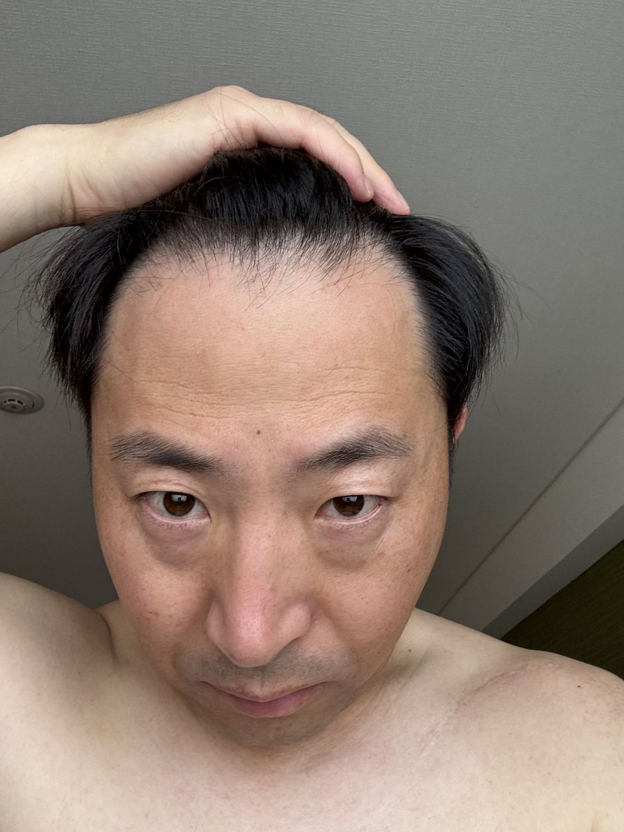 Musk_Lyu's tweet photo. 吃生發藥滿兩個月，如期拍照對比。有什麼變化嗎？ https://t.co/0G5sIiPtNJ