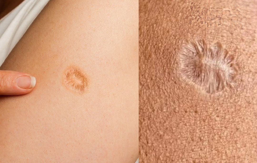 RevisableAI's tweet photo. Which vaccine is most commonly associated with this characteristic scar ?
#neet2 https://t.co/AMMZoOJA5y