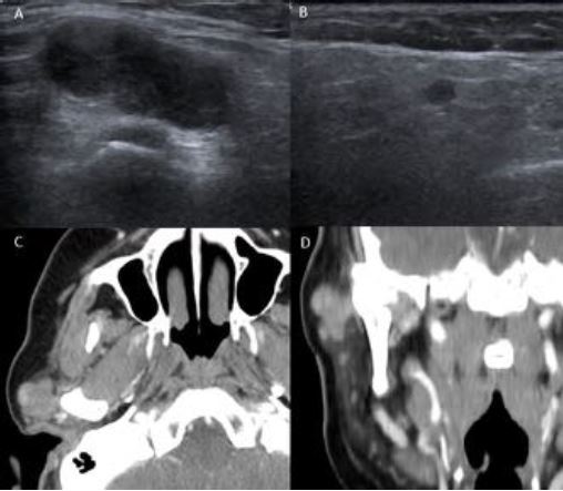 SECOMmxf's tweet photo. 👉Radiation-induced undifferentiated spindle cell sarcoma following adenoid cystic carcinoma of minor salivary gland, by #RECOM

✅https://t.co/znI20jT4DD   #SECOMmxf https://t.co/0rJIujXLAi