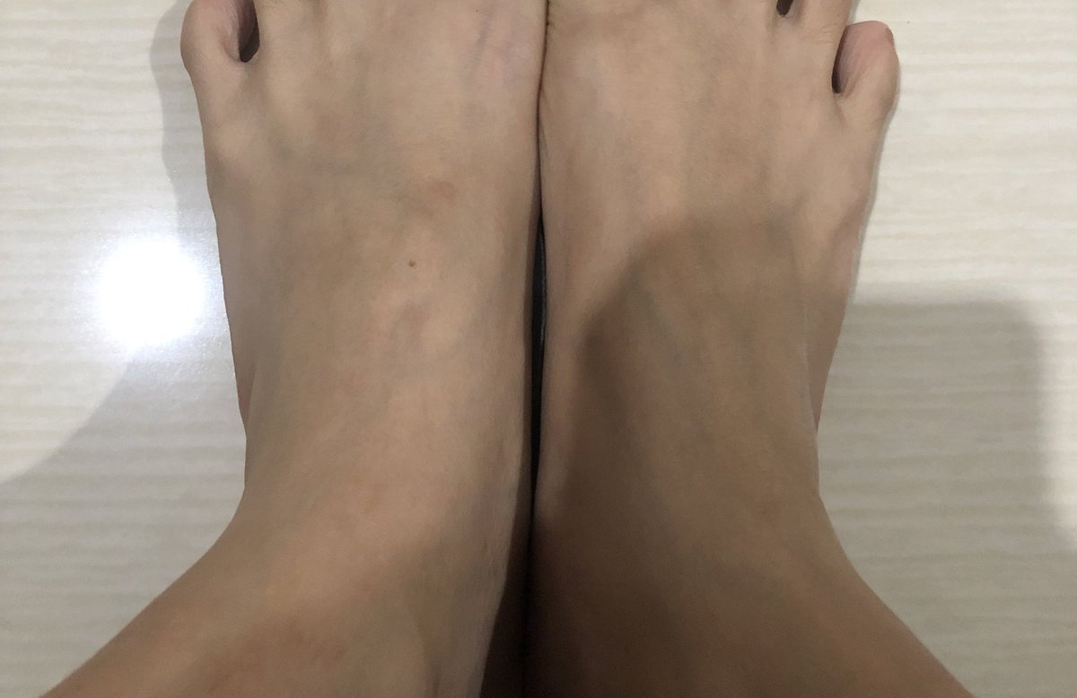 hareilzan_'s tweet photo. Sekitar tahun 2023 kena eksim kering, awalnya cuma gatal bintik2 kecil gitu. Terus dikasih salep china malah makin parah eksimnya, sampai berair (pic 1) 😭

Akhirnya aku konsul ke halodoc https://t.co/xRthnUwkvH