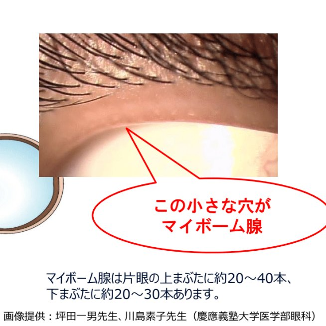 eyeshampoo's tweet photo. まぶたの縁に白いツブツブ、気になったことない？
それ、#マイボーム腺 が詰まっているサイン。

この腺は涙の油分を分泌して目の乾きを防いでいるけど、メイク残りや皮脂で詰まると機能しなくなる。
それが、ドライアイ・ゴロゴロ感・ものもらいの原因になることも。

まぶた、ちゃんと洗えてますか？ https://t.co/V6UQbQT2oK