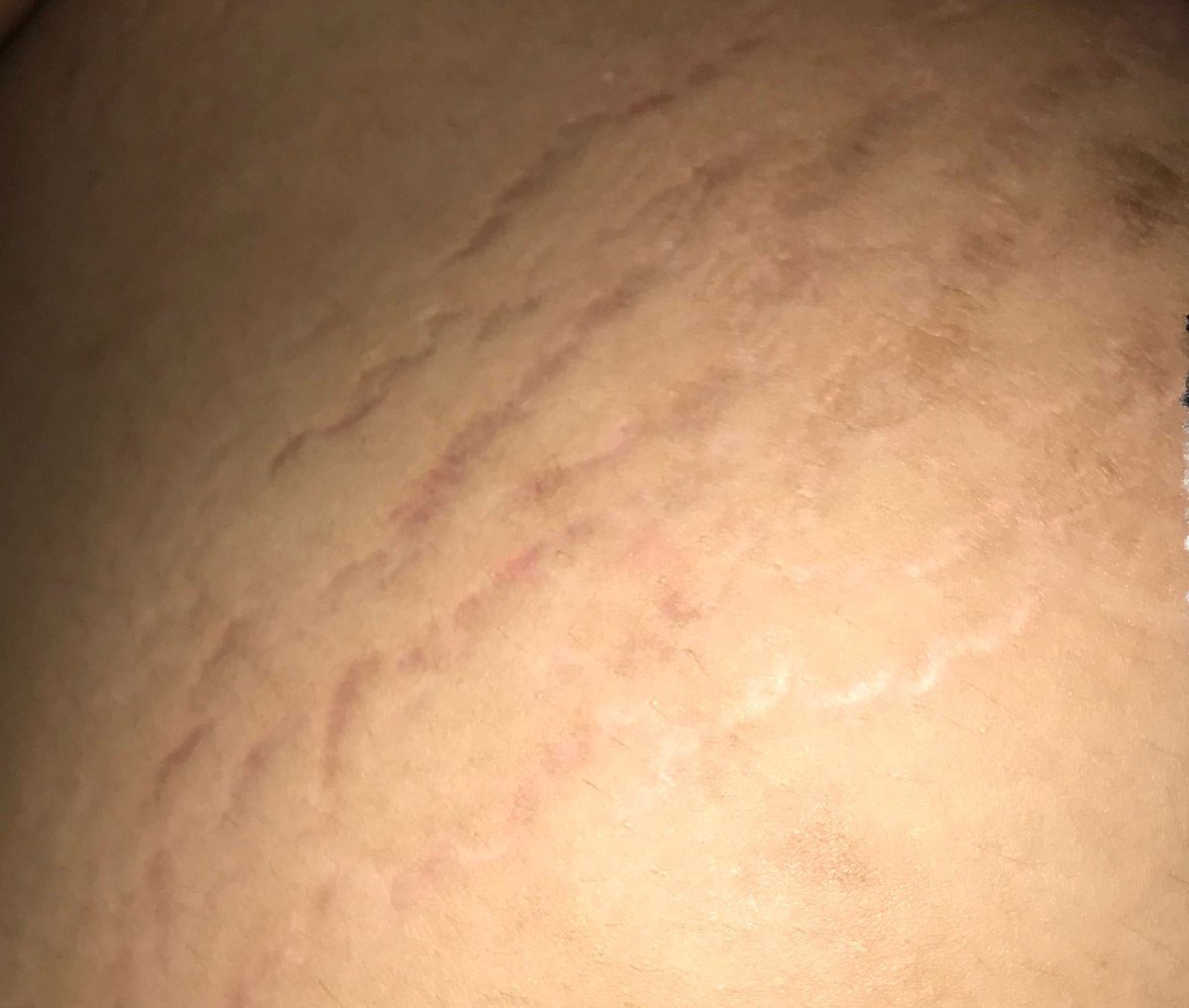 Buterrcream's tweet photo. GAIS PLS SINI KUMPUL!!
Akhirnya setelah sekian lama, stretchmarkku mulai pudar juga😭

Gak muluk-muluk langsung ilang ya, tapi ini progresnya kelihatan banget👍🏻💯 https://t.co/lswJk7mFUe