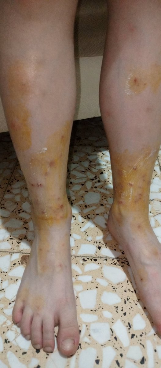 AlminaNevin's tweet photo. Durumumuz yetmediği için daha düşük bütçeli evler tutuyoruz. Evler böcek dolu tahtu kurusu dolu. Çocuğumu yiyorlar böyle oluyor vücudu artık. Sizden tek istediğim ev almamızda bize edeceğiniz naçizane bir yardım istiyorum.Takdir sizindir @sedat_peker #iyikivarsınsedatpeker https://t.co/sd4VtO3H8g