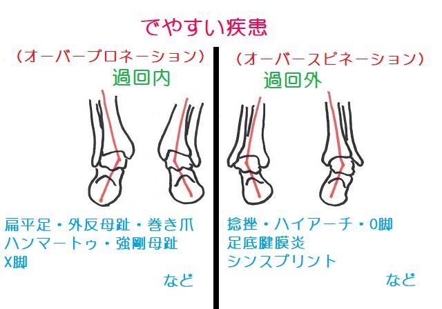 hondaseikotsu's tweet photo. 🦶 回内足（過回内）になると、どんな症状が出やすい？

かかとが内側に倒れた状態が続くと、足全体のバランスが崩れ、さまざまな疾患につながりりす。

─────────────────
⚠️ 過回内でなりやすい疾患
─────────────────

・扁平足
・外反母趾
・巻き爪
・ハンマートゥ
・強剛母趾
・X脚　　　　　　　　など

アーチがつぶれることで足指や膝への負荷が変わり、これらの問題が起こるといわれています。

─────────────────
📌 過回外（オーバースピネーション）の場合は？
─────────────────

逆にかかとが外側に傾く「過回外」では、

・捻挫
・ハイアーチ
・O脚
・足底腱膜炎
・シンスプリント

などが起こりやすい傾向。

─────────────────

同じ「足首の傾き」でも、内側か外側かで出やすい症状はかなり異なります。

「自分はどちらのタイプ？」と気になった方は、
ぜひ一度足の状態をチェックしてみてください🔍