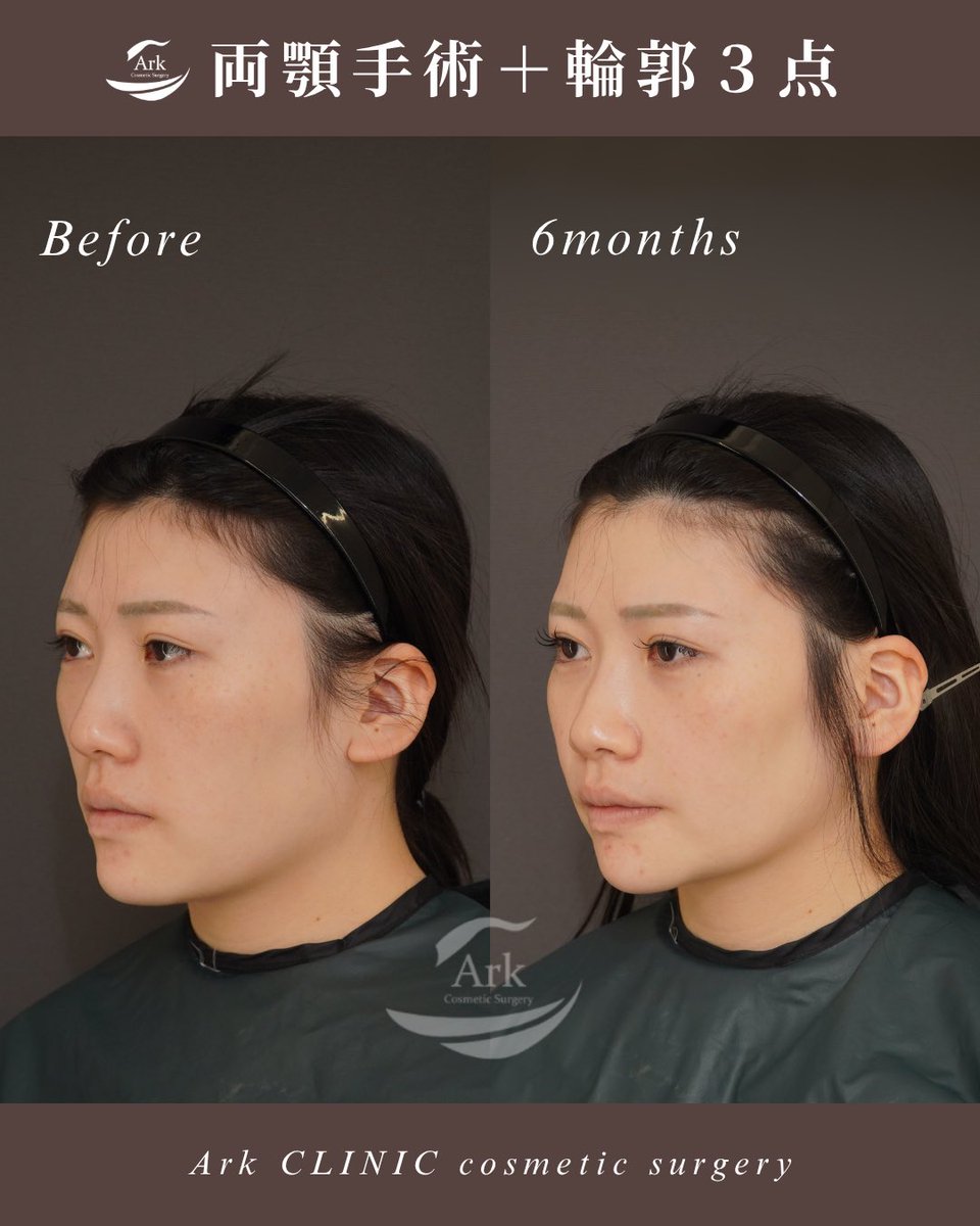 ark_clinic's tweet photo. 【術後6ヶ月症例】

「中顔面の長さが気になる」というお悩みで、両顎手術＋輪郭3点を行った患者様です。

術後6ヶ月で腫れも落ち着き、フェイスラインがすっきりとした印象に。
また、上顎・下顎の位置を整えることで、中顔面の長さが目立ちにくくなり、顔全体のバランスも改善しています。

中顔面短縮は単純に骨を削るだけではなく、骨格全体のバランスを見ながら治療計画を立てることが重要です。

同じお悩みをお持ちの方は、ぜひ一度カウンセリングへお越しください。

※術後経過には個人差があります。