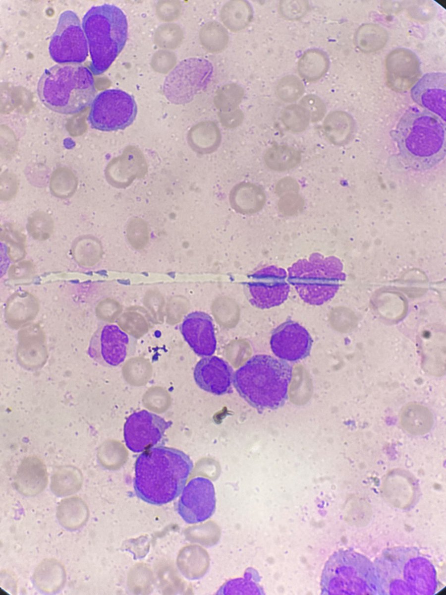 ibtisamshowkat_'s tweet photo. L2 or M1
#leukemia #cancer #hematology
#oncology #bonemarrow #ash @ASH_hematology @nihardesai89 @IhabFathiSulima https://t.co/kWoaGTN9gU