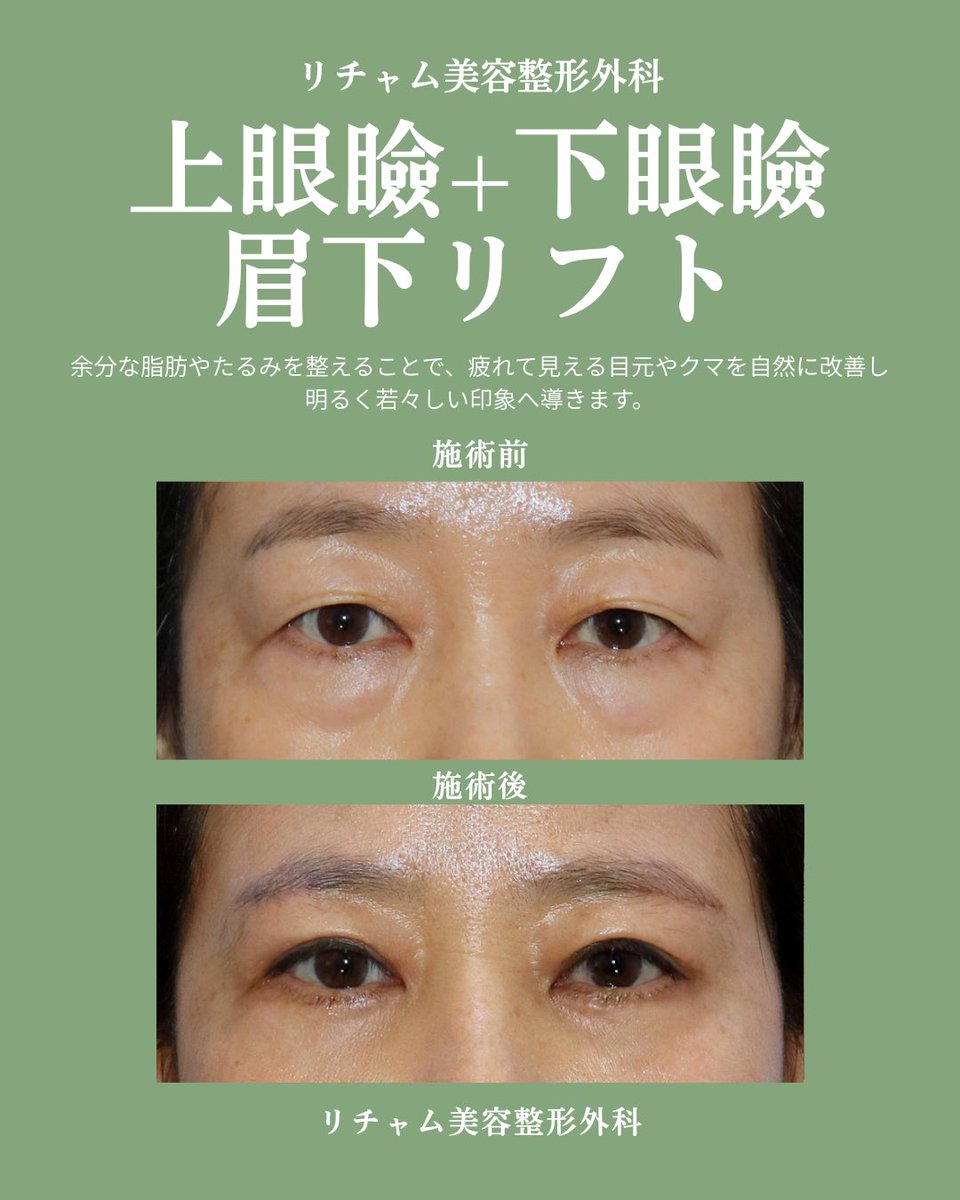 liftingreal2's tweet photo. リフトアップが上手なリチャム美容整形外科です✨

今回は目元若返り症例のご紹介🪄
目元のたるみは状態によって手術方法が変わります。

今回はクマ取りだけでなく、まぶたの外側のたるみが強かったため上眼瞼手術＋眉下リフトを併用。
自然な目元の変化が見られました。

#韓国美容 #まぶたのたるみ https://t.co/JgqGSio20O