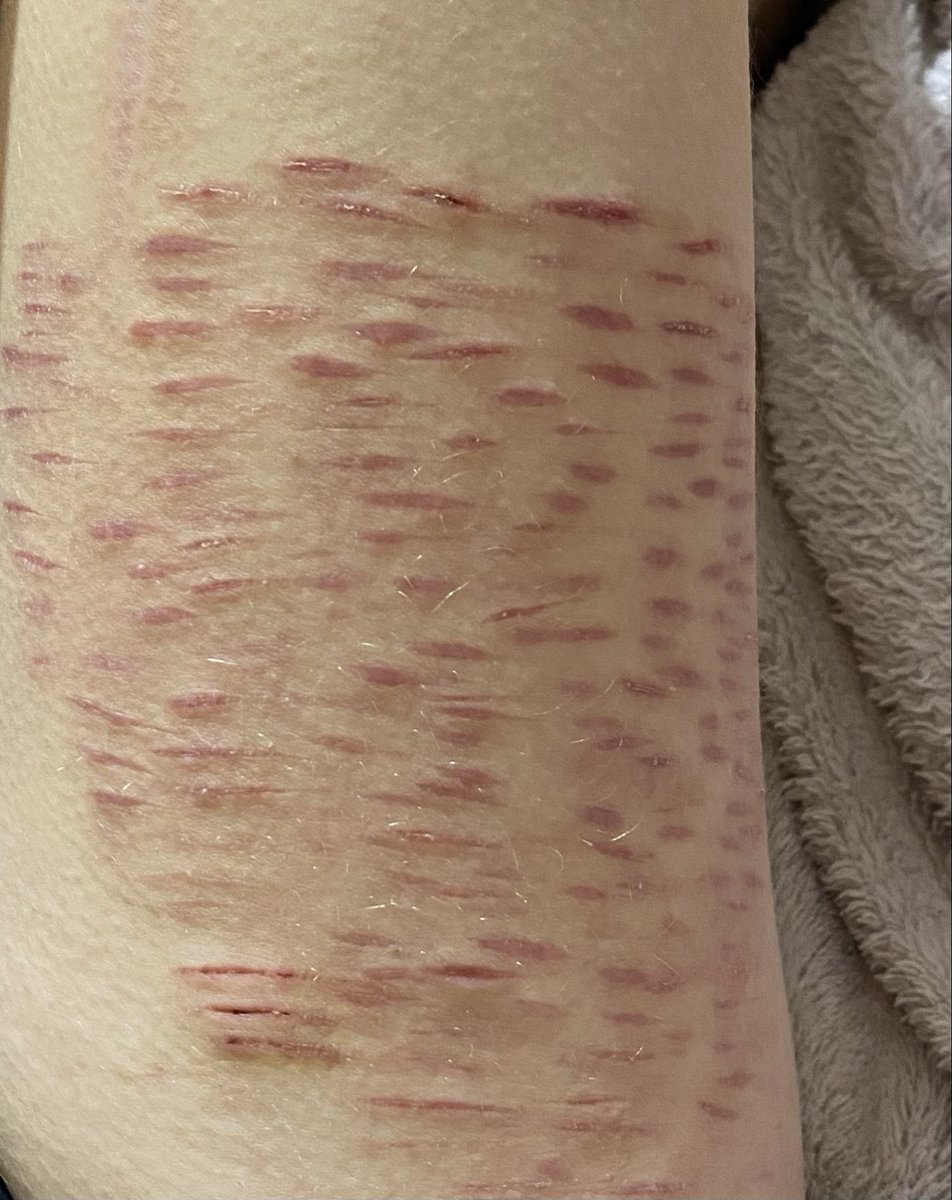 sahaoLaow's tweet photo. My scars are so itchy https://t.co/VXXFaDxAVd