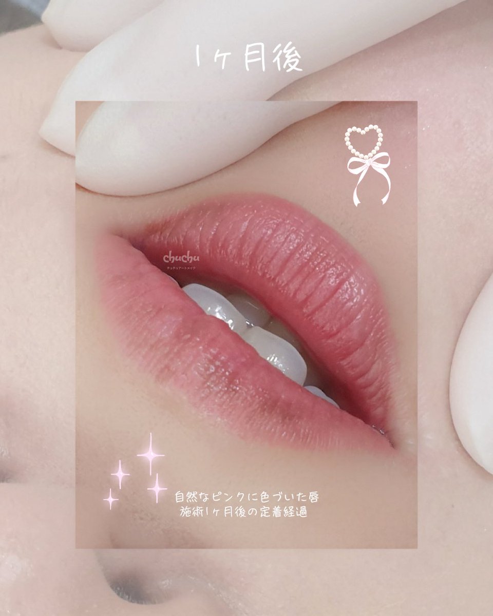 chuchu_artmake's tweet photo. 施術から1ヶ月後、自然になじんだリップアートメイク🌷
ほんのりピンクに色づき、すっぴんでも血色感のある可愛らしい唇に。
毎日のリップメイクをしなくても、やさしく明るい印象を演出できます💕

𖦹 . ⋆ ° ⊹ ｡ ⋆  ᰔ ⋆ ｡ ⊹ ° ⋆ .  𖦹 

🍃人中短縮×小鼻効果
🍃じんわりリップ
🍃ぽってりM字リップ
🍃整形級

🎀 施術項目
・リップアートメイク
・眉アートメイク
・アイライン
・涙袋アート
・ヘアライン

𖦹 . ⋆ ° ⊹ ｡ ⋆  ᰔ ⋆ ｡ ⊹ ° ⋆ .  𖦹

※ 少人数制でのご案内となります。
🔖初回 ¥5,000 OFF

👩‍⚕️KC・ISO認証色素を使用しています。
👩‍⚕️滅菌済みの使い捨て器具で、安全に施術しております

📍 韓国・日本 全地域出張可能です ✈️
📲 ご予約・ご相談はプロフィールのLINEより

｡ﾟﾟ･｡･ﾟﾟ｡ ⠀ ⠀ ⠀ ⠀ ⊹ ⠀ ⠀ ⠀ ⠀ 💕 ⠀ ⠀ ⠀ ⠀ ⠀ ⠀✧⠀ ⠀💕
ﾟ。⠀ 　｡ﾟ
　ﾟ･｡･ﾟ cнυcнυ ⠀ ⊹ ⠀ ⠀ ⠀ ⠀ ✧ ⠀ 💕
⠀ ⠀ ⠀ ⠀ ⠀ ⠀ ⠀ ⠀ ⠀ ⠀ ⠀ ⠀ ⠀ ⠀💕⠀ ⠀ ⠀ ⠀ ⠀ ⊹ ⠀💕⠀ ⠀✧

#リップアートメイク #ピンクリップ #グラデーションリップ #血色リップ #ナチュラルリップメイク