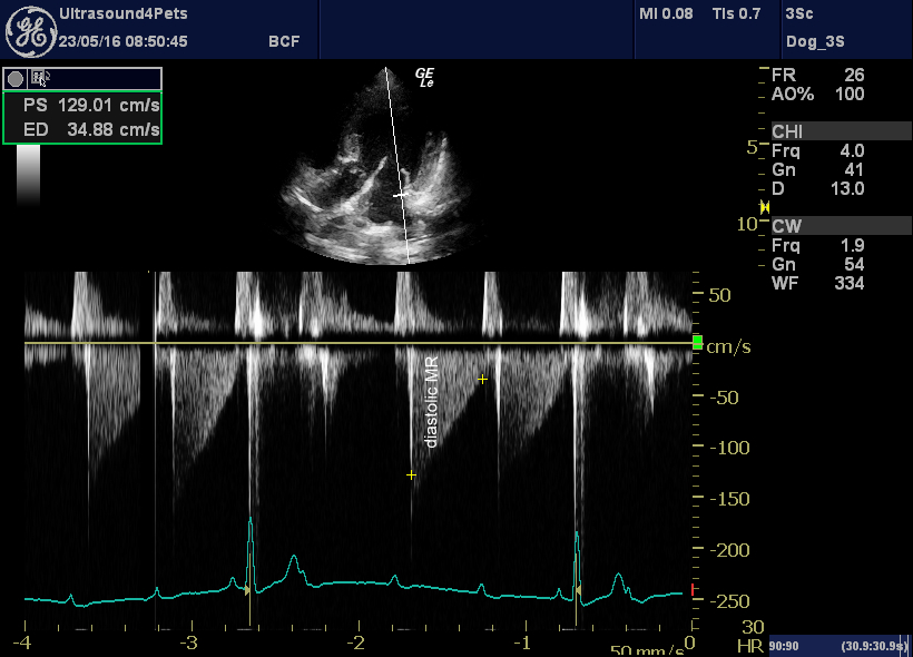 RitikaTuliMD's tweet photo. CardioNugget™ 🫀

Why does diastolic MR occur in acute severe Aortic Regurgitation?

1️⃣ Acute severe AR → rapid filling of a noncompliant LV
2️⃣ LVEDP rises dramatically
3️⃣ LV diastolic pressure exceeds LA pressure → premature mitral valve closure
4️⃣ LV pressure continues to rise in late diastole → blood is forced back across the closed mitral valve = diastolic MR

Often accompanied by premature MV closure and a normal-sized LV in acute severe AR.

#CardioNugget™ #EchoBoards #EchoFirst #ASEcho #Cardiology #FOAMed #BoardPrep #AorticRegurgitation