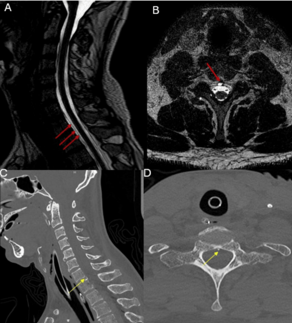 DocNavarrow's tweet photo. 👮‍♂️A 41-year-old man presented with 2 months of persistent headache, dizziness, and acute confusion. Brain CT revealed bilateral subdural hematomas without a history of trauma. The images below helped identify the underlying cause.

🏥What's the etiology? https://t.co/PumTbFU1qY