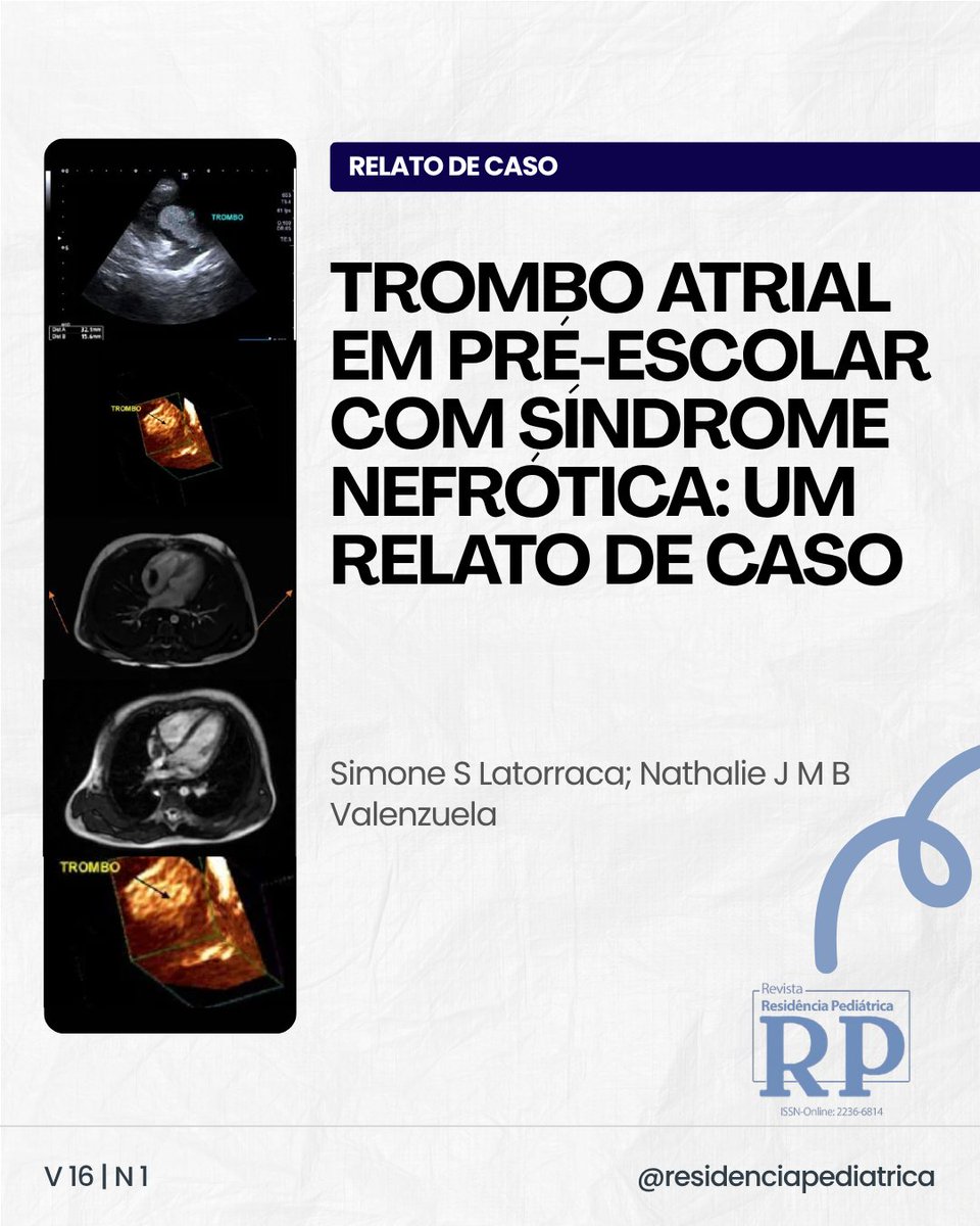 ResidPediatrica's tweet photo. Novo artigo publicado!
Trombo atrial em pré-escolar com síndrome nefrótica: um relato de caso.

Confira o artigo completo acessando a revista RP, v16, n1: https://t.co/sMY5Kll3QX

#Trombose #Cardiopatias #Síndromenefrótica https://t.co/2z1bKTtwEh