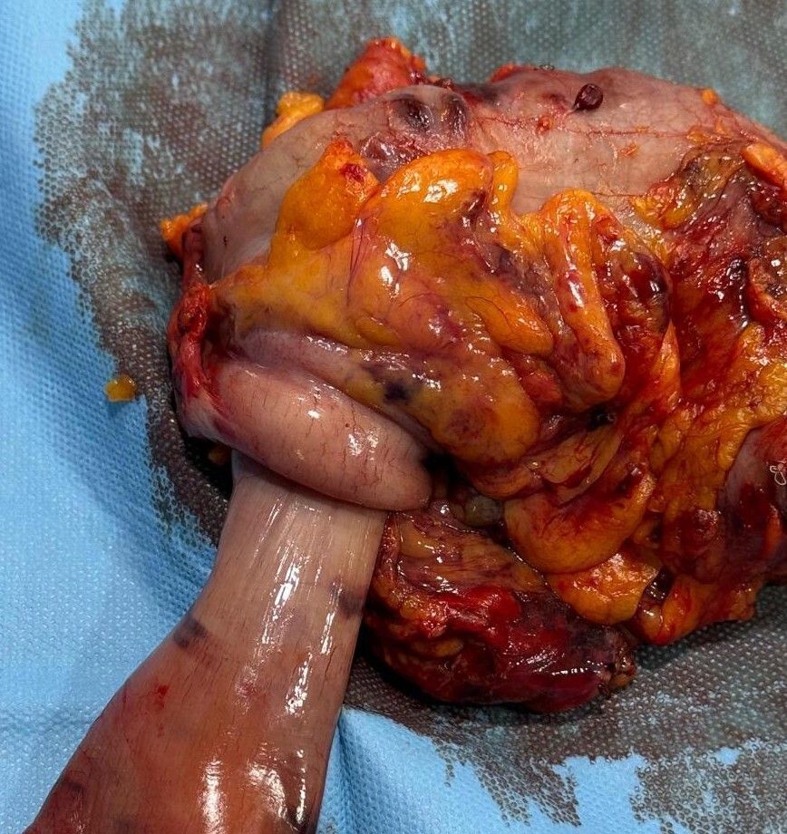 CirugiaHUVR's tweet photo. 🔄 Invaginación intestinal en el adulto: siempre hay una causa orgánica detrás: pólipo, tumor o lesión como cabeza de invaginación.
A diferencia del niño, no se reduce. Se opera.
⚠️ Masa palpable + obstrucción: pensar en invaginación.
🏥 @HospitalUVRocio
#CirugíaGeneral https://t.co/FFt120ufLh