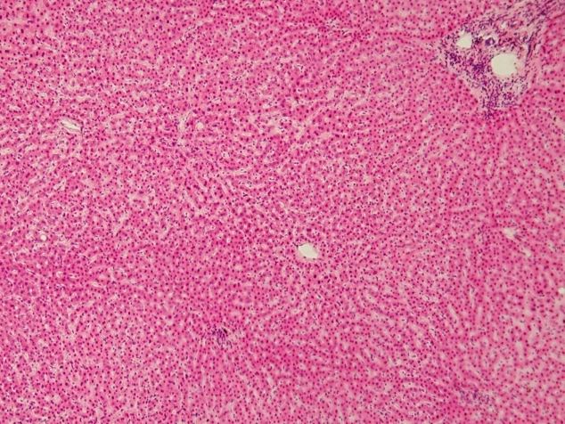 cancerscnews's tweet photo. Researchers including Dr. Yu-Fei He propose a framework in which #hepatocytes dedifferentiate into bipotent progenitors as a pre-malignant state, undergo malignant transformation, and a subset acquires #stemness through DNMT-mediated reprogramming.
π‘ https://t.co/mw8ntri7Xu https://t.co/E2iPUIiV2J