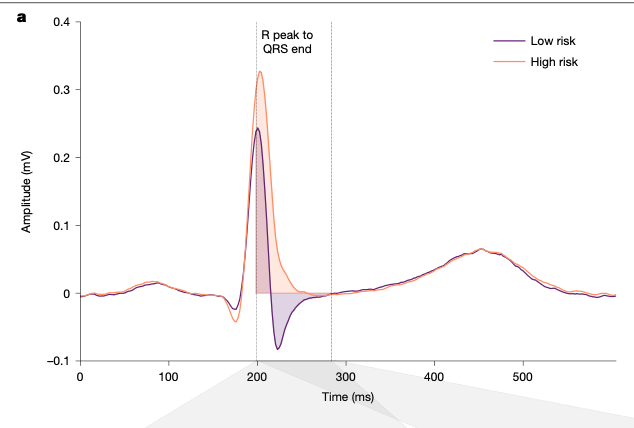 LuisOliverio's tweet photo. El único predictor que usamos para muerte súbita es la FEVI (fracción de eyección del ventrículo izquierdo). 
Analizaron casi 800 mil ECG en Suecia, Estados Unidos y Taiwán para predecir fibrilación ventricular-taquicardia ventricular, y lograron un AUC 0.87.

Pero lo más interesante fue que descubrieron un “biomarcador” en los ECG anormales: una morfología rara en el complejo QRS (específicamente en la derivación aVL), un empastamiento (slurring) en la porción terminal de la onda R, en lugar de la onda S negativa y afilada.

Es por ahora solo una hipótesis, y se necesitan estudios clínicos aleatorizados para determinar la utilidad real, pero está muy interesante. Nature (2026).