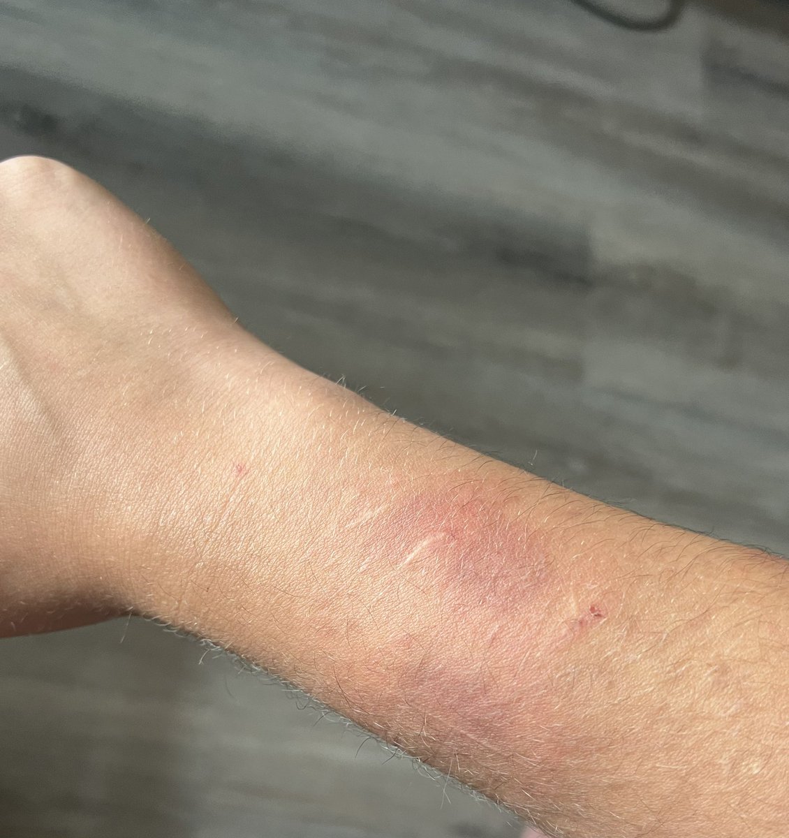 Border_d0zen's tweet photo. genuinely how tf
these are the fattest bruises ive ever had https://t.co/kDVlxC1plj
