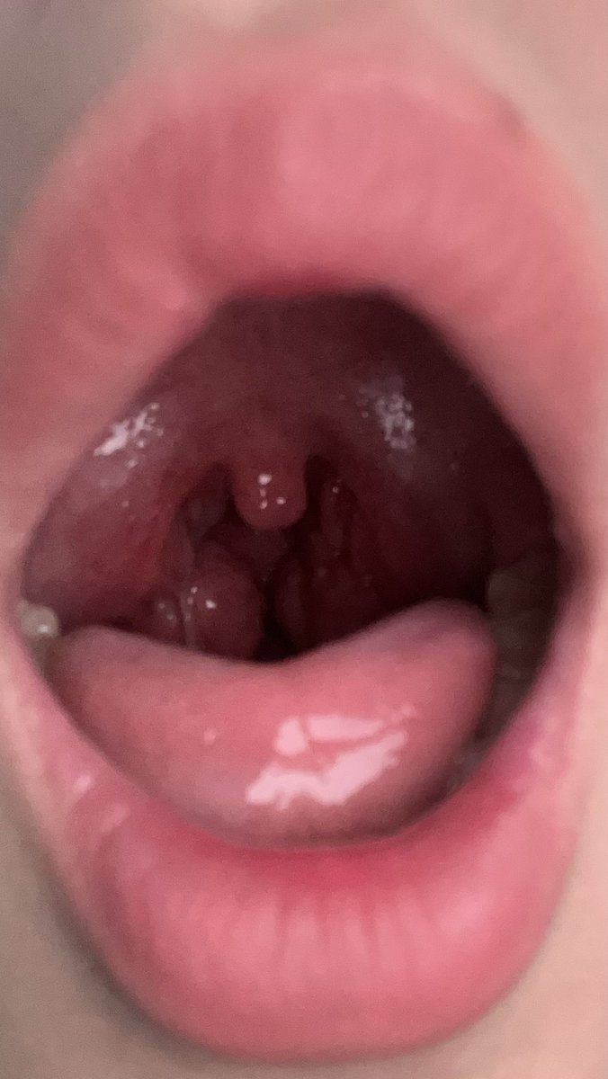 gyullri's tweet photo. my throat is so swollen man https://t.co/hBCCmGnDtc