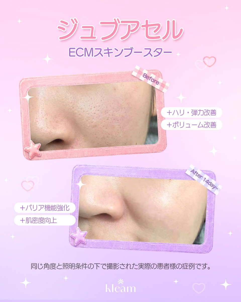 kleamjp's tweet photo. 今話題の施術であるクリィムの「ジュブアセル 」をご紹介致します✨

💖 ハリ・弾力アップ＆自然なボリューム改善
💖 肌のバリア機能を強化
💖 肌密度を高めて、よりなめらかな肌へ

毛穴は目立ちにくく、ハリはふっくら！
ECMスキンブースターで、肌の内側から満ちるようなボリューム感をご体感ください😊
