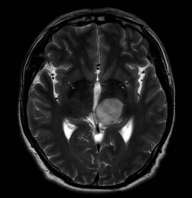 XiefengWang's tweet photo. Just finished a low grade thalamic glioma resection using a supracerebellar endoscopic approach, based on the knowledge learning from the skull base course at Mayo Clinic. Grateful to my mentor's @GLanzinoNSGY  recommendation and to @PerisCelda 's outstanding teaching. https://t.co/NnGMH75oqE