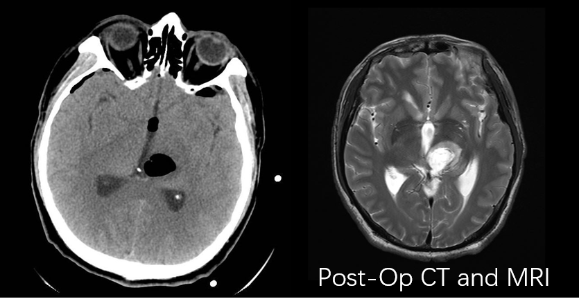 XiefengWang's tweet photo. Just finished a low grade thalamic glioma resection using a supracerebellar endoscopic approach, based on the knowledge learning from the skull base course at Mayo Clinic. Grateful to my mentor's @GLanzinoNSGY  recommendation and to @PerisCelda 's outstanding teaching. https://t.co/NnGMH75oqE