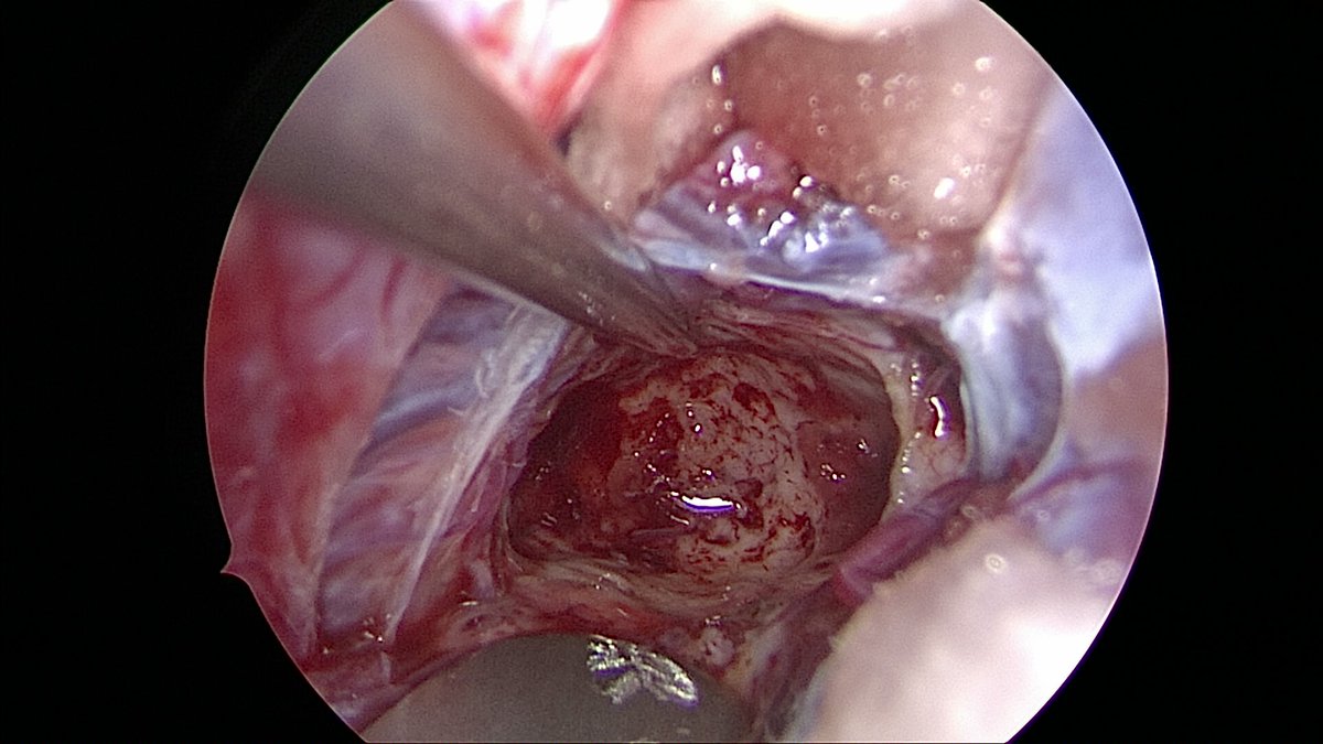XiefengWang's tweet photo. Just finished a low grade thalamic glioma resection using a supracerebellar endoscopic approach, based on the knowledge learning from the skull base course at Mayo Clinic. Grateful to my mentor's @GLanzinoNSGY  recommendation and to @PerisCelda 's outstanding teaching. https://t.co/NnGMH75oqE