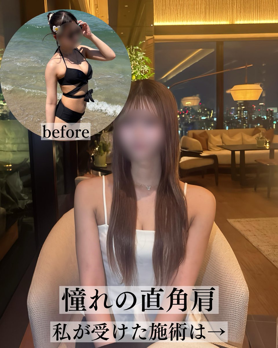 dr_kamitani's tweet photo. 二の腕全体の太さより
「付け根」や「肩」の太さ気になりませんか？
むしろそこだけが気になる人って意外と多いんです

ダイエットでは細くなりにくく
脂肪吸引でシルエットを整えるのがおすすめです https://t.co/E0Pw34A7Kc
