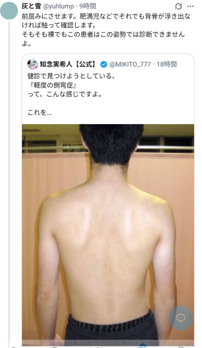 MIKITO_777's tweet photo. 【CV：古畑任三郎】

えー、あなた、こうおっしゃいました。

『側弯は体操着の上から余裕で診断できます』
『素人でも簡単です』

と。

でも、この方の写真を見て、

『裸でもこの患者はこの姿勢では診断できませんよ』

ともおっしゃる。

んー、おかしいですね。

いえ、私には肩甲骨と肩の位置がずれているのが一目瞭然なんですよ。

ほとんどの医師ならこれで側弯症を疑うはずなんです。

でもあなたは、素人でも体操服の上から簡単に側弯症を診断できると言っていたのに、
裸のこんな明らかな側弯症を見逃してしまう。

んー、あなたはご自身で『女医』だと主張しているのに、同時に『素人以下である』ということになってしまう。

これはどういうことでしょう？

それにですね、あなたは
『背骨が浮き出なければ触って確認します』
ともおっしゃいましたね。

でもね、本当のお医者さんなら、
『側弯症の診断では背骨ではなく、肩や肩甲骨の位置で診断する』ということをご存知ないわけがないんです。

あと、『側弯症を見つけても意味がなん』なんて絶対言わないんです。

だってそうでしょ。
子どもの側弯症は、成長するにつれて悪化することが少なくないんだから。

軽度でも経過を見て、必要に応じて治療するんですよ。

んー、あなた、ミスをしました。

女医を名乗るなら、もっと医学のことを勉強しないと。

それに、Xにデタラメを投稿したのも感心しません。

Xにはツイ廃の本物のドクターがたくさんいて、人々、特に子どもに害になるような嘘は片っ端から暴こうと、手ぐすねを引いているんですよ。

ん、ふっふっ

あなたの浅い知識によるデタラメな投稿、
間違いを指摘されてからの無駄な言い逃れ、
ぜんぶ墓穴を掘りまくっていたんです。

あなたは、医学知識が皆無であることを、自ら告白してしまっていたんです。

これは、チェックメイトというやつだと思うのですが、いかがでしょうか。

えー、古畑任三郎でした。