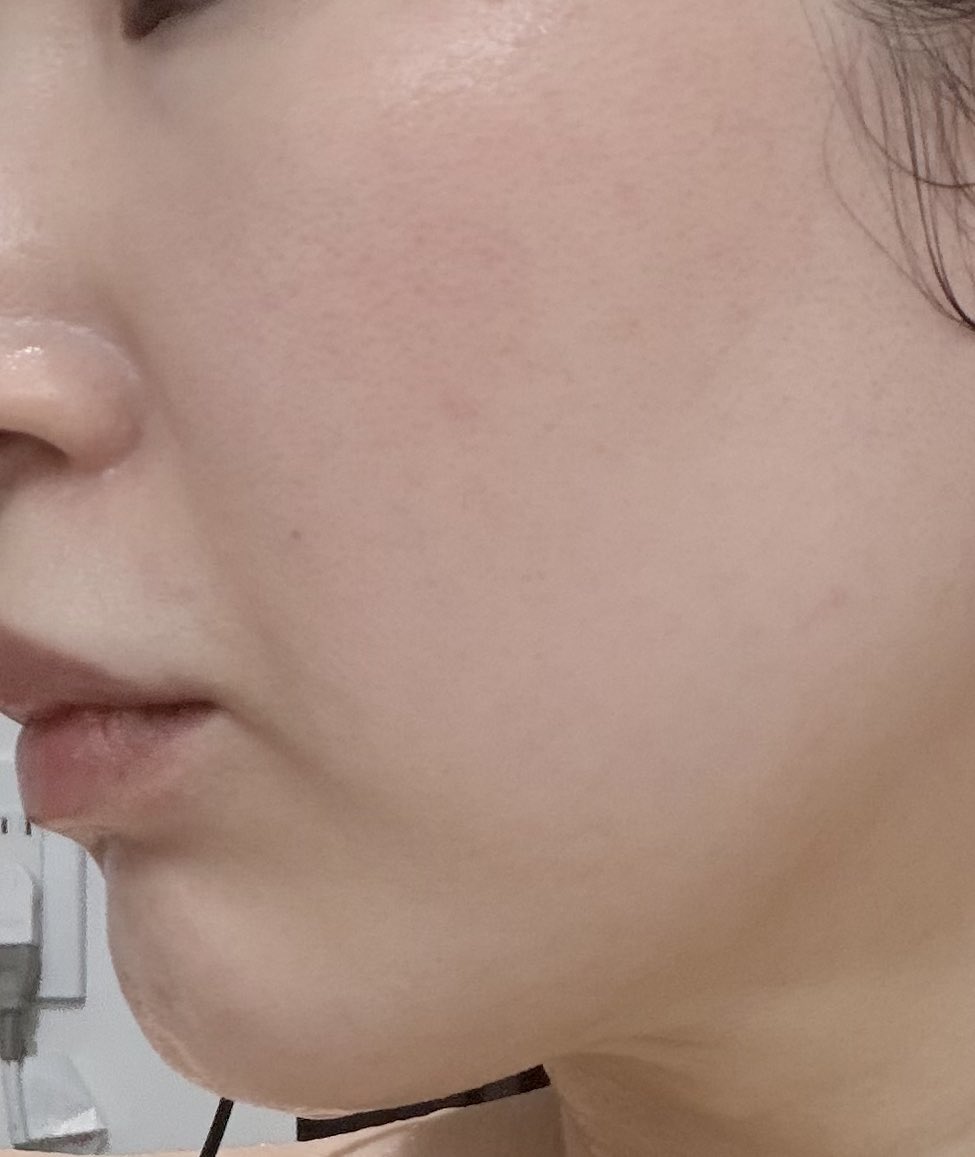 pikafes's tweet photo. アイティンでリトゥオとスキンボトックスを受けてきました！疲れてた中顔面が少し元気になってきた気がして嬉しい、経過を見ます！ https://t.co/i6qS29buHB