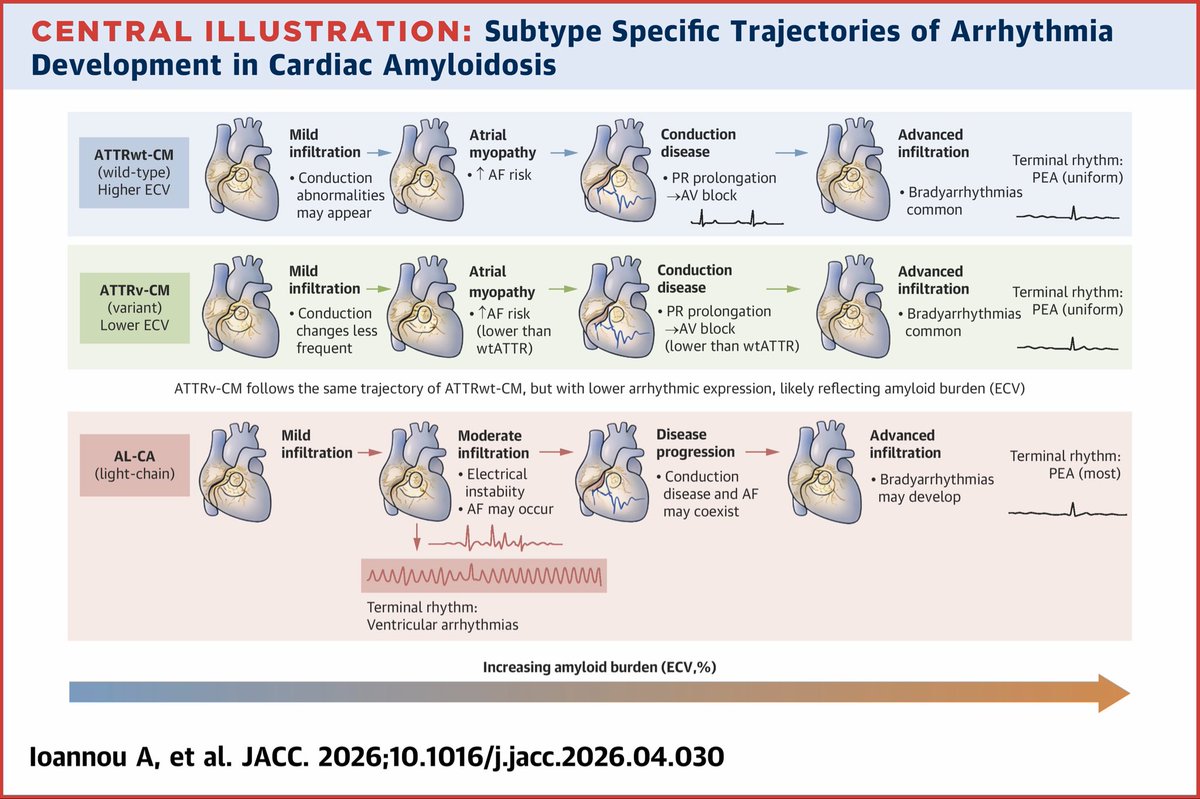 YevgeniyBr's tweet photo. Incidence of arrhythmias in patients with cardiac amyloidosis with routine ILR from National amyloidosis center. 
Study cohort: 110 patients: 63 ATTR-CA (40 ATTR wild type and 23 ATTR variant) and 47 AL-CA 
Median follow-up of 36 months. 
@JACCJournals https://t.co/wdVo3Um4MZ https://t.co/eOLqNLREbd