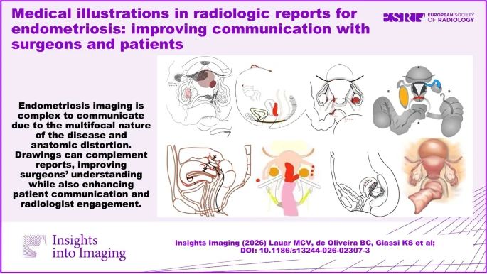 InsightsImaging's tweet photo. A new review highlights the growing role of medical illustrations as a powerful complement to radiology reports in endometriosis care.

🧠 Helps translate complex, multicompartmental disease spread into clear visuals
🩺 Improves communication between radiologists, surgeons, and patients
📈 Supports surgical planning, counseling, and follow-up monitoring
🤝 Encourages shared decision-making and patient understanding 

https://t.co/qLHK0Gcw0S (Marcela Caetano Vilela Lauar et al.)