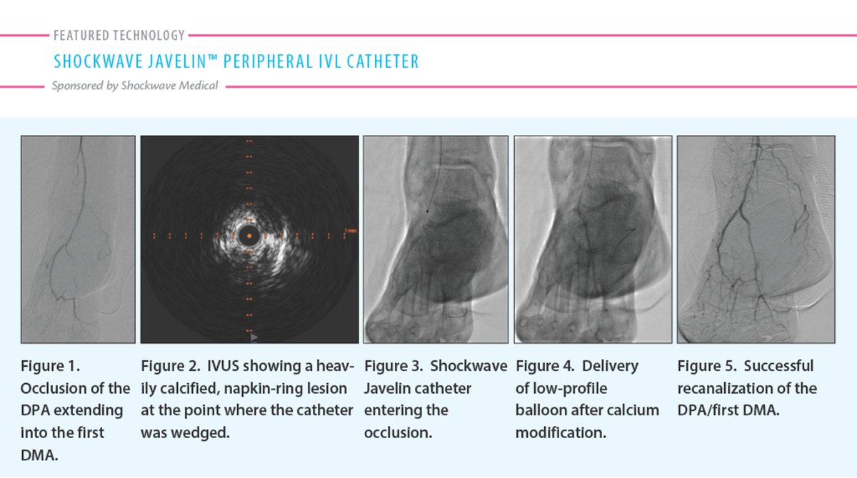 Shockwave Medical tweet media