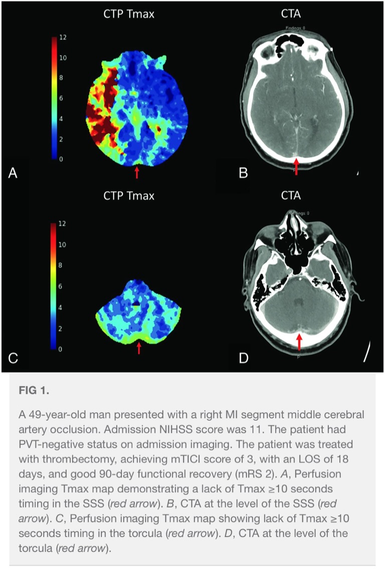 TheAJNR's tweet photo. Check #AJNR Fellows’ Journal Club choice of the month: ‘’Prolonged Venous Transit on Perfusion Imaging: An Evolving Marker of Outcomes in Large Vessel Occlusion Stroke: A Comprehensive Review’’

Prolonged venous transit (PVT) is an emerging perfusion imaging biomarker that reflects microvascular integrity and venous outflow dysfunction in acute ischemic stroke due to large vessel occlusion. Studies show that PVT-positive status is associated with higher stroke severity, larger perfusion deficits, prolonged hospitalization, and worse 90-day functional outcomes and mortality after mechanical thrombectomy. Compared with conventional arterial perfusion parameters, PVT demonstrated stronger prognostic accuracy, particularly when combined with CBV index. These findings support incorporating PVT into routine AIS-LVO imaging assessment to improve outcome prediction and evaluation of postrecanalization microcirculatory dysfunction.

https://t.co/5YCik1ilOk

#medstudent #neuroradiology #neuroscience #radiology #medschool