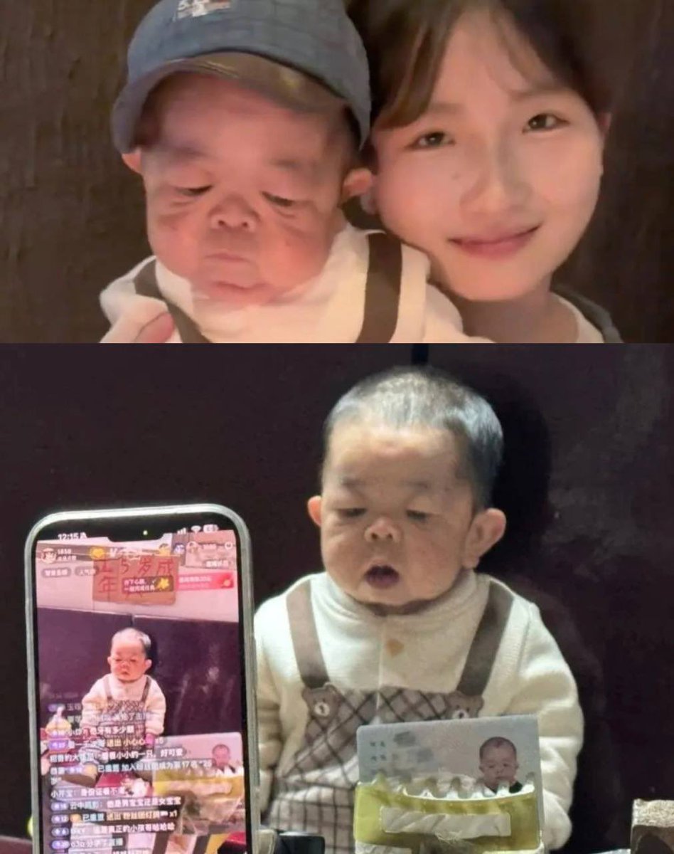 MorbidKnowledge's tweet photo. Wang Junming is 25 years old. He goes to bed before 8pm, needs help with every basic task, and his family still call him baby. He is 66 centimetres tall, the size of a one-year-old child.

Wang, from Hunan Province in central China, was diagnosed this February with pituitary hormone deficiency, a condition in which the pituitary gland fails to produce the hormones that control growth and metabolism. 

His family had struggled to identify or afford treatment for years. His father worked as a construction worker on a low income. 

For most of Wang's life, no doctor had given them a name for what was happening. 

Three years after Wang was born, his parents had his younger sister Xiaoling. 

When Xiaoling was in elementary school, their mother was diagnosed with terminal cancer. 

Until then Xiaoling had been distant from her brother, but the diagnosis changed everything. 

She decided to stay home after graduating from nursing school rather than move to the city, taking a job at a local clinic in Changsha so she could remain close.