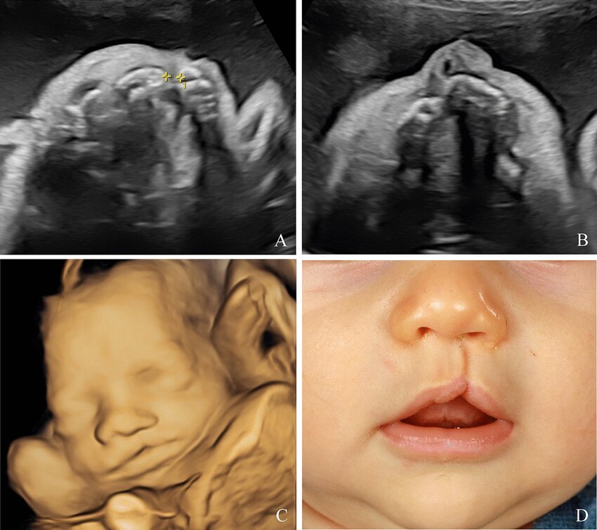 ZahoorAhmed1450's tweet photo. Which anticonvulsant is associated with cleft lip and palate in fetus?

A) Lamotrigine
B) Valproate
C) Carbamazepine
D) Phenytoin https://t.co/UwN9E3jo7s