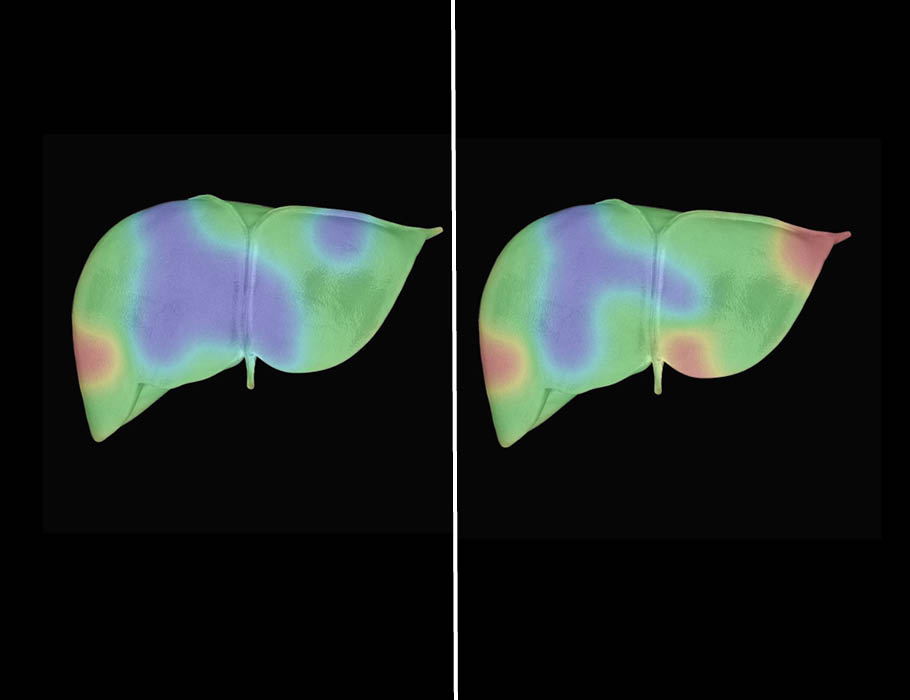 ScienceTM's tweet photo. Scientists have applied noninvasive optical coherence tomography (#OCT) to evaluate tissue quality across the entire surface of human donor liver candidates, suggesting that OCT could complement traditional invasive biopsy approaches. @sbme_ou https://t.co/5cmSBF83eb https://t.co/pqVaFKfS1P