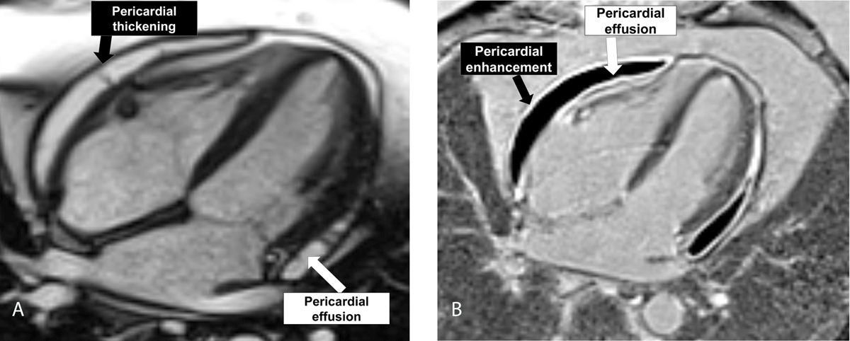 DeBakeyCVedu's tweet photo. New MMI! "Effusive-Constrictive #Pericarditis" by Jad Zeitoun et al. 

Watch videos at https://t.co/bLJpxPHtBh 
#DeBakeyCVJournal https://t.co/w427PDLQ43