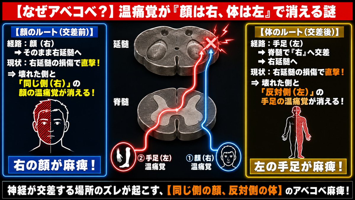 kokusistsenta's tweet photo. 【完全攻略】
もう迷わない「延髄外側症候群（ワレンベルグ）」総まとめ。

国試で一番怖いのは、「舌下神経はセーフ！」と必死に覚えたのに、 本番で『ホルネル症候群』や『めまい・眼振（小脳失調）』が並んで出てきて結局失点するパターン。

実は、ワレンベルグの複雑な症状は、すべて「1本の軸」で繋がっています。

・疑核障害（ベロ動くのに嚥下・発声がバグる）
・ホルネル症候群（瞳孔が縮み、瞼が下がる）
・前庭核・小脳失調（めまい、眼振で立てない）
・交差性感覚障害（顔は同側、体は対側の温痛覚が消える）

これらすべて、延髄の「外側（端っこ）」にギュッと密集している代表選手たちです。

覚えるときは個別に丸暗記するのではなく、 「延髄外側は『のどの奥、顔と体の温痛覚ルート、バランスセンサー』の超密集地帯。

だから一気にやられる」と捉えてください
脳の引き出しが1つにまとまります

今週解説した図解2枚をセットで置いておきます。 いつでも見返せるように【保存】しておきましょう！