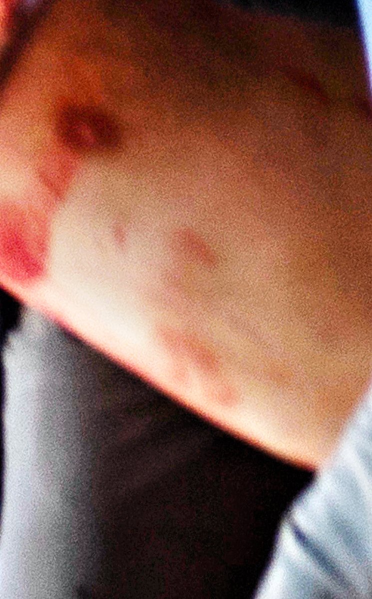 baroncoleman's tweet photo. @paramounttactcl @AshtonForbes Explain the marks on Charlie’s chest where the necklace was. Here’s an image with the contrast turned up. https://t.co/8SyCWcX3d4