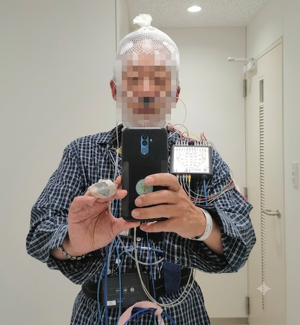 SRV250S_BB's tweet photo. 先週、PLMDの確定診断をする為に、
終夜睡眠ポリグラフ(PSG)の検査入院を
してきました。
鼻の下の黒色はチョビ髭じゃなくて
酸素チューブの連結部分のパイプですよ~(笑)
#終夜睡眠ポリグラフ
#PSG
#PLMD
https://t.co/yrxFovBXlH https://t.co/PP5tNkTix5