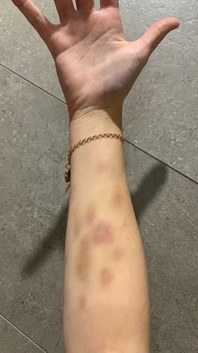 goatlicker2000's tweet photo. how i’d sh when i couldn’t cut 
#sh #bruising #cuts https://t.co/YNnmpi27Vo