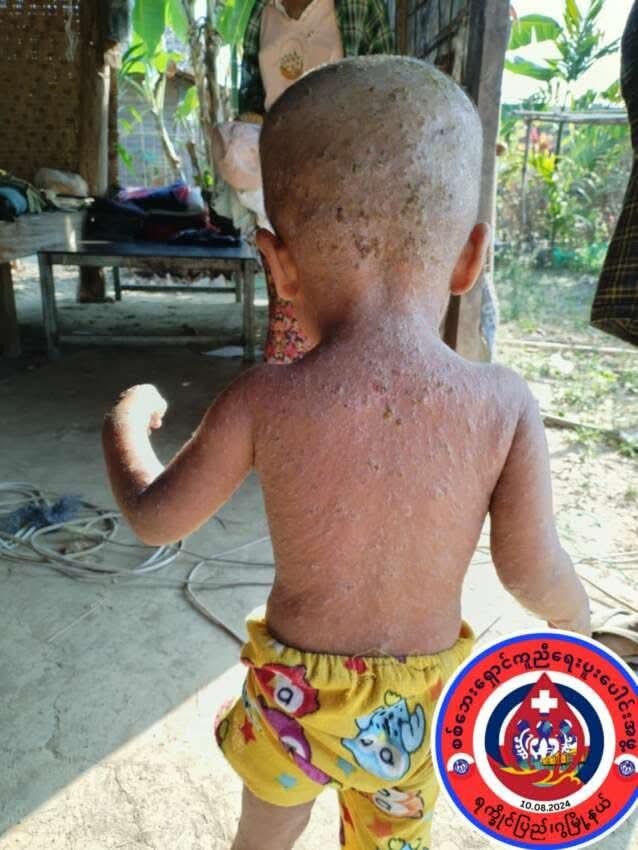 MizzimaNews's tweet photo. ရခိုင်က စစ်ဘေးရှောင် ၄,၀၀၀ ကျော် အရေပြားရောဂါ ကူးစက်မှု ဆိုးဝါးနေ၊ ဆေးဝါးအရေးပေါ်လိုအပ် 

#စစ်ဘေးရှောင်
#ယားနာရောဂါ
#ကူးစက်ဖြစ်ပွားမှု
#ရခိုင်ပြည်နယ်
#AA
#MizzimaBurmeseNews
-------
သတင်း အပြည့်အစုံကိုဖတ်ရှုရန် >> https://t.co/qOe3zQvLIP https://t.co/BfDSw6gxCx