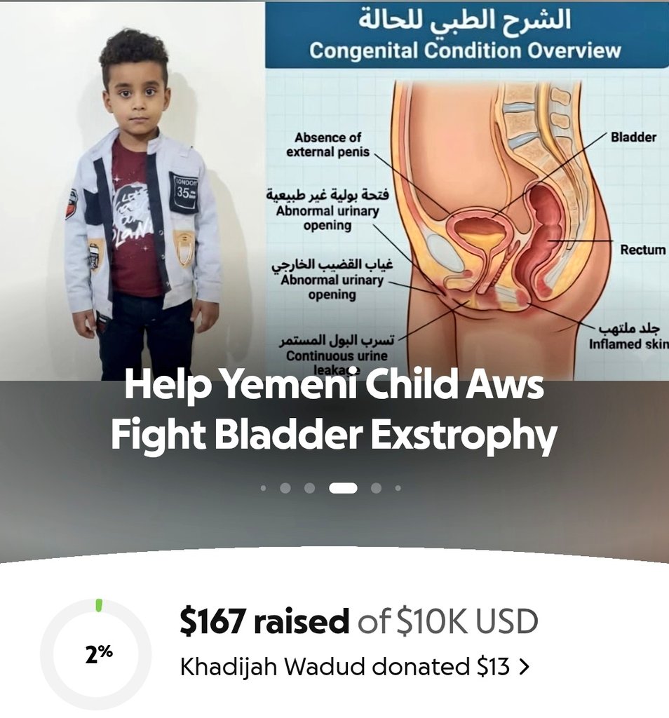 BilqisYeme6i's tweet photo. 💔 Aws is a Yemeni child suffering from a rare congenital condition and needs several surgical operations to have a chance at a normal life
Contribute what you can, and if you cannot, reposting this tweet might save his life🙏🇾🇪
#Save_Aws #Yemen #Donate
https://t.co/gPYZzWieOf https://t.co/BZCaH3iijk