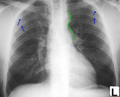 thediabetes_doc's tweet photo. The "figure-of-3 sign" on chest X-ray suggests:

A. Aortic dissection
B. Coarctation of the aorta
C. Pulmonary hypertension
D. Aortic stenosis
E. Aortic aneurysm https://t.co/GEEXGKCZhM