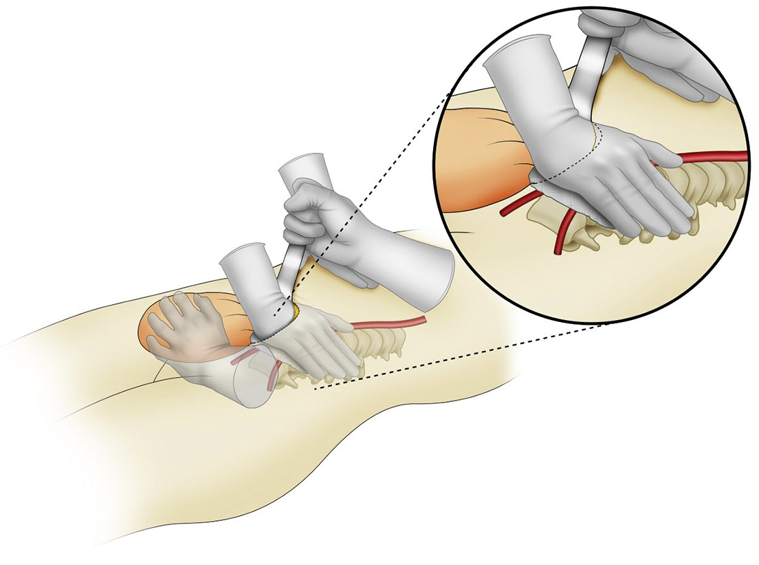 AJOG_thegray's tweet photo. AJOG Surgeon's Corner: Internal manual compression of the aorta—an effective way to temporarily control pelvic bleeding in obstetrical hemorrhage - Internal manual compression of the aorta https://t.co/pPwEy2NI2L https://t.co/Rq0GuWECzH